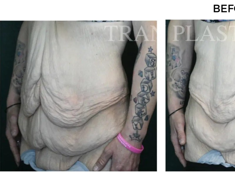 Procedure before and after - before