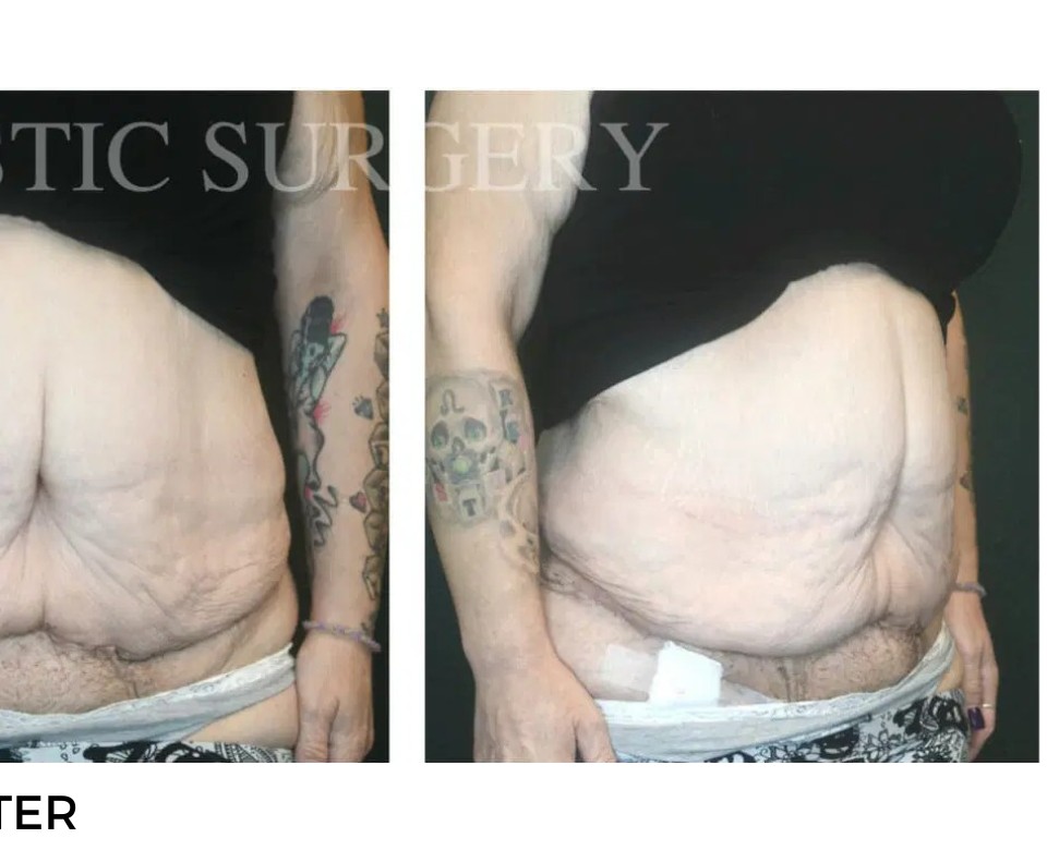 Procedure before and after - after