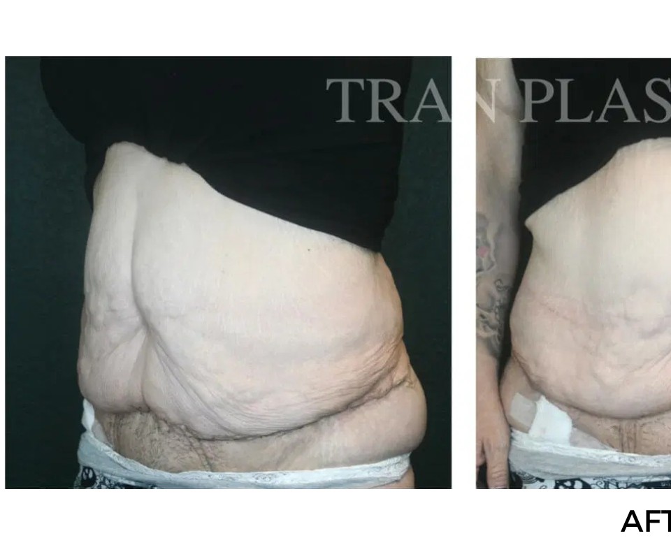 Procedure before and after - before