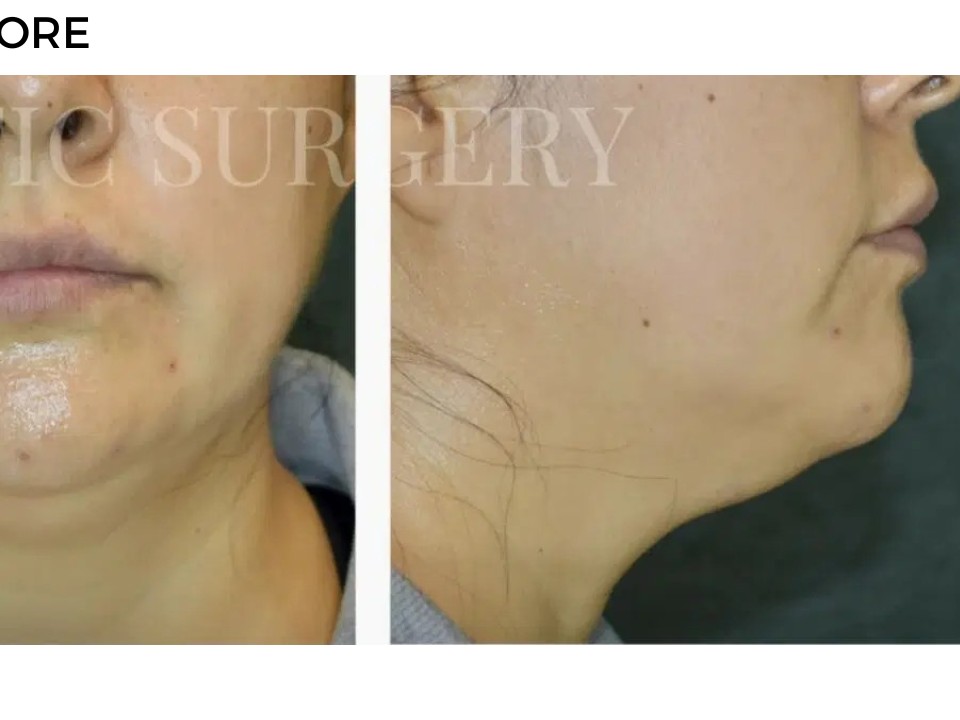 Procedure before and after - after