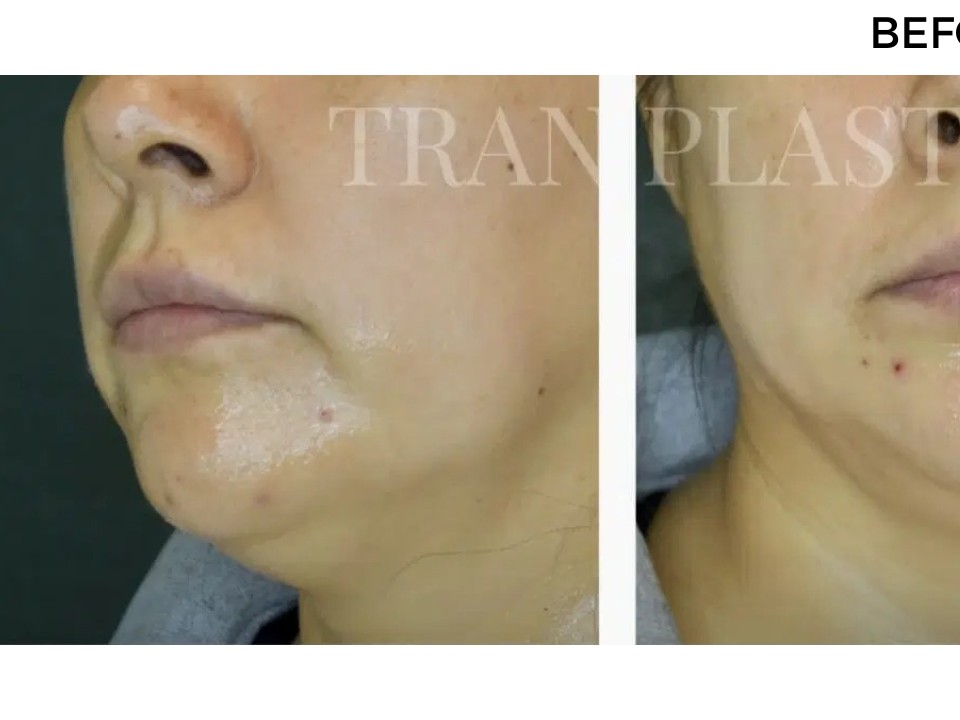Procedure before and after - before