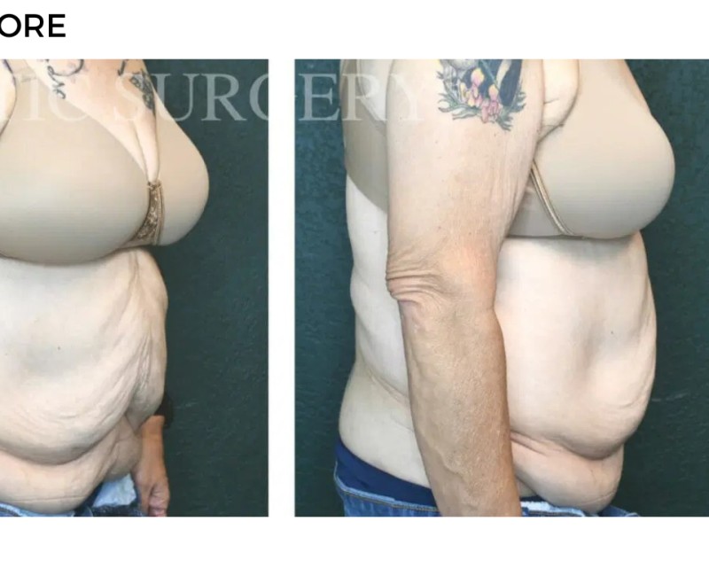Procedure before and after - after