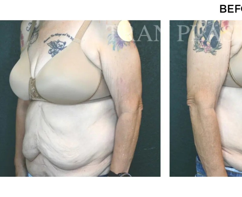 Procedure before and after - before