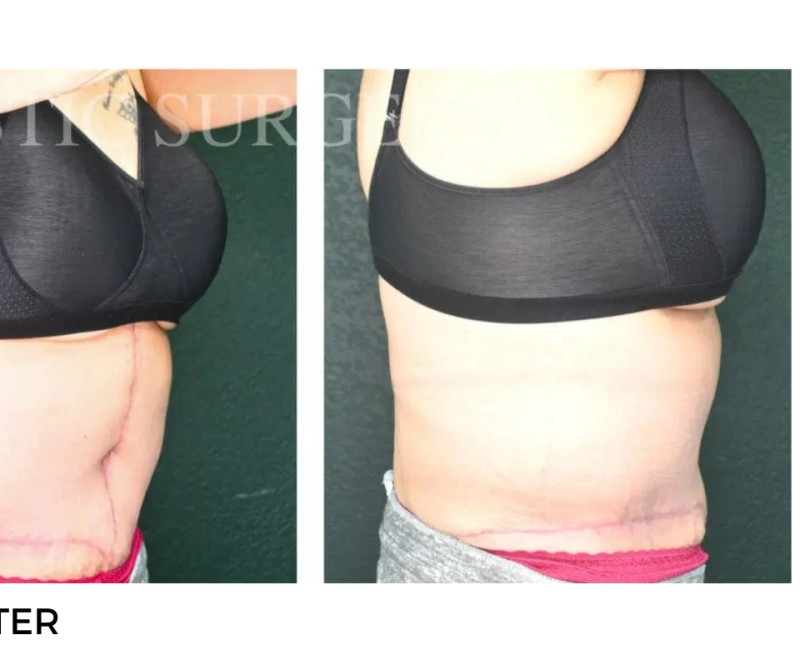 Procedure before and after - after