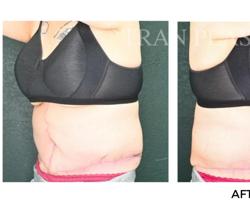 Procedure before and after - before