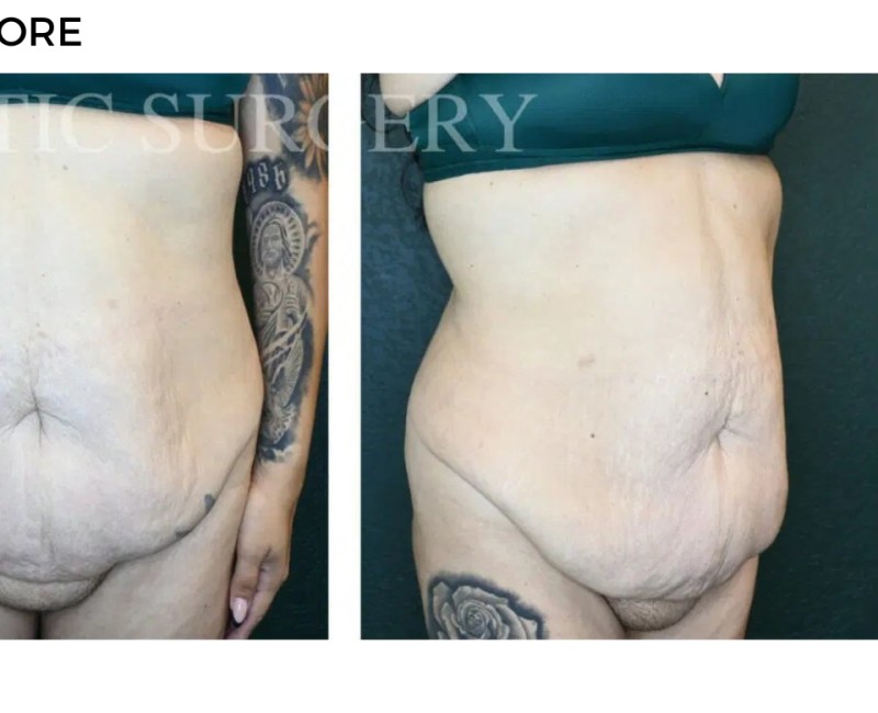 Procedure before and after - after