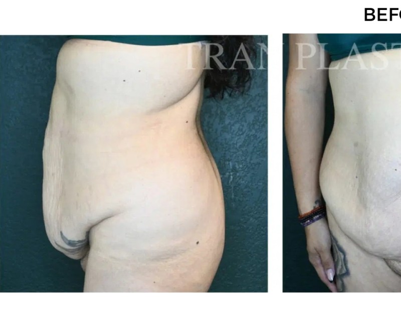 Procedure before and after - before