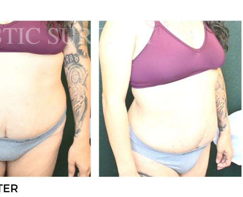 Procedure before and after - after