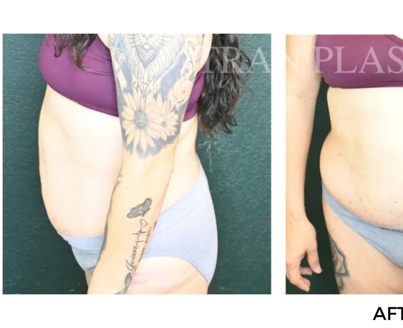 Procedure before and after - before