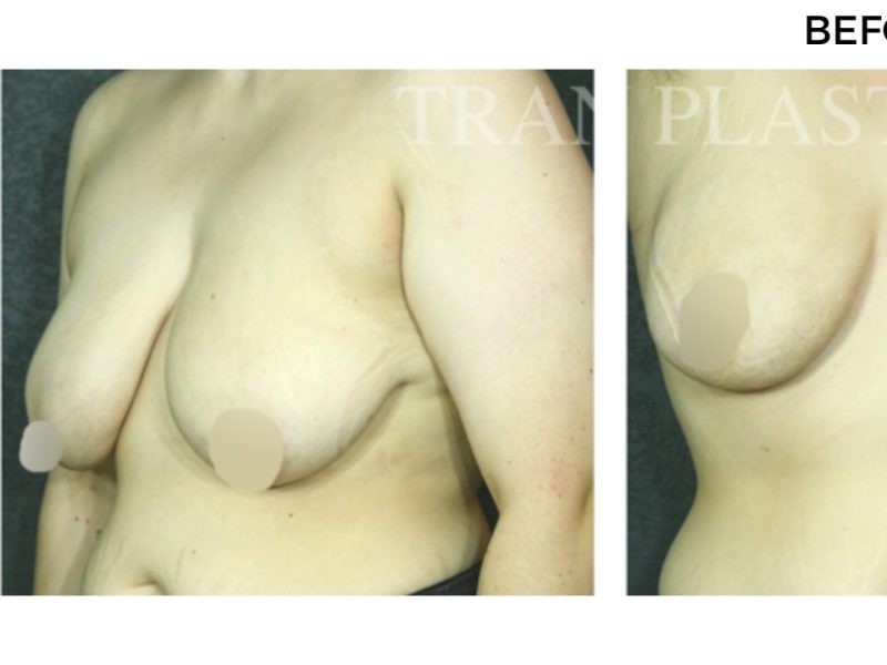 Procedure before and after - before