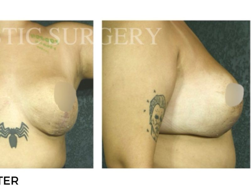 Procedure before and after - after