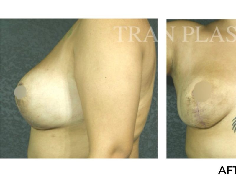 Procedure before and after - before