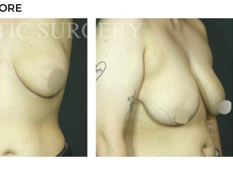 Procedure before and after - after