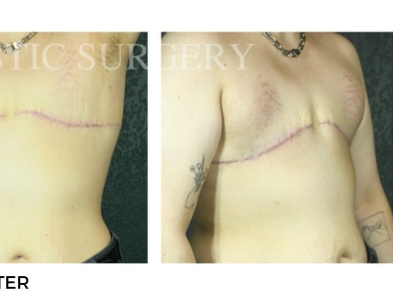 Procedure before and after - after