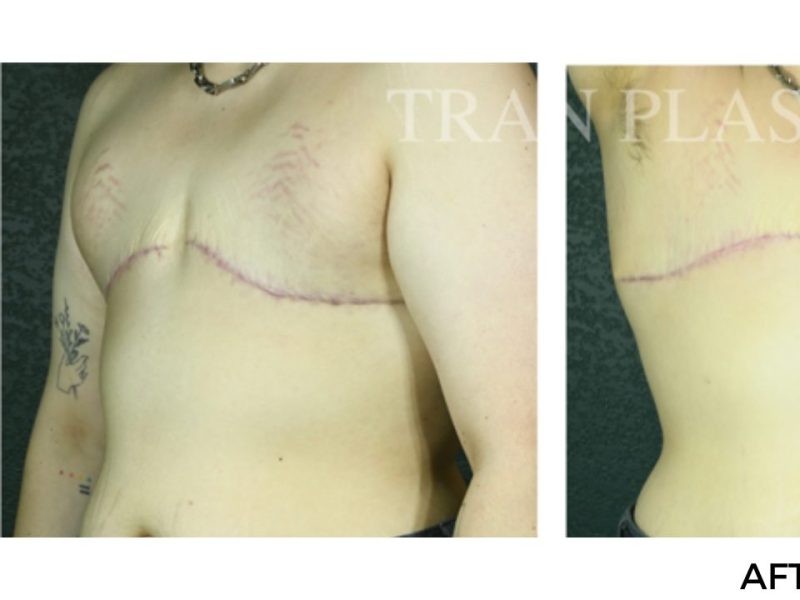 Procedure before and after - before
