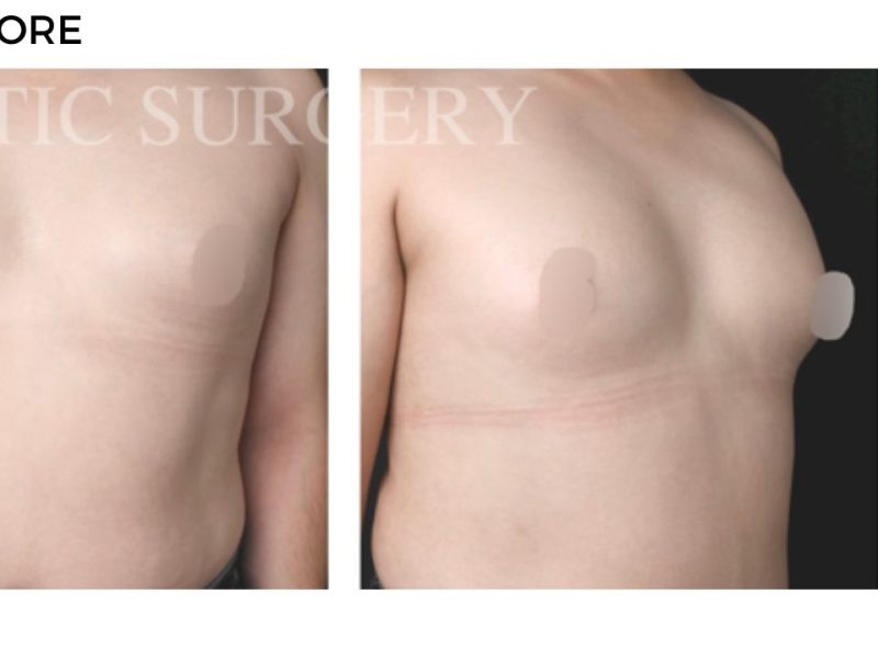 Procedure before and after - after