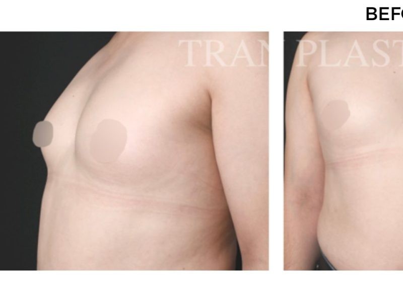 Procedure before and after - before