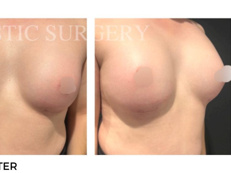 Procedure before and after - after