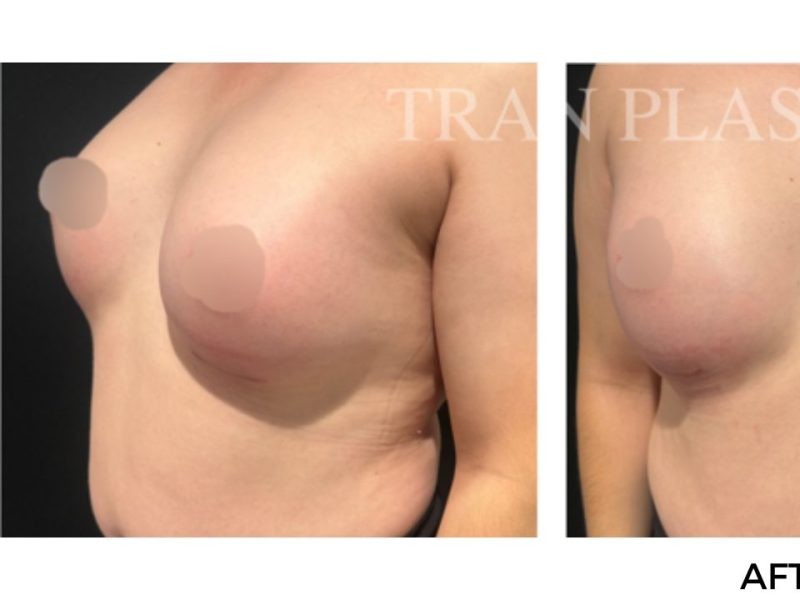 Procedure before and after - before
