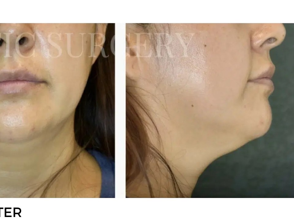 Procedure before and after - after