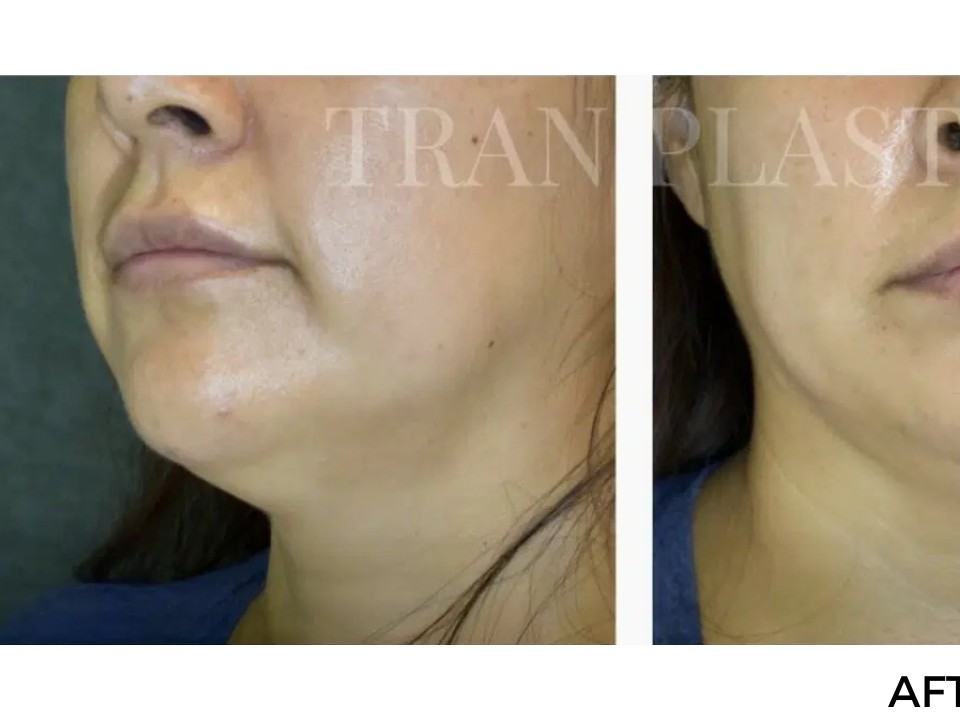 Procedure before and after - before