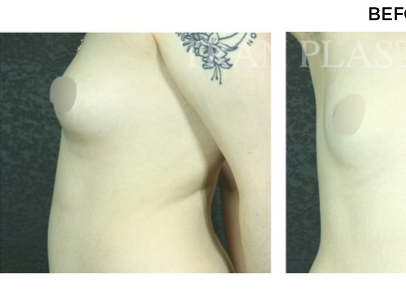 Procedure before and after - before
