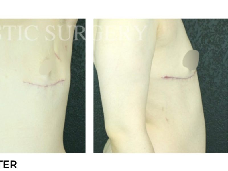 Procedure before and after - after