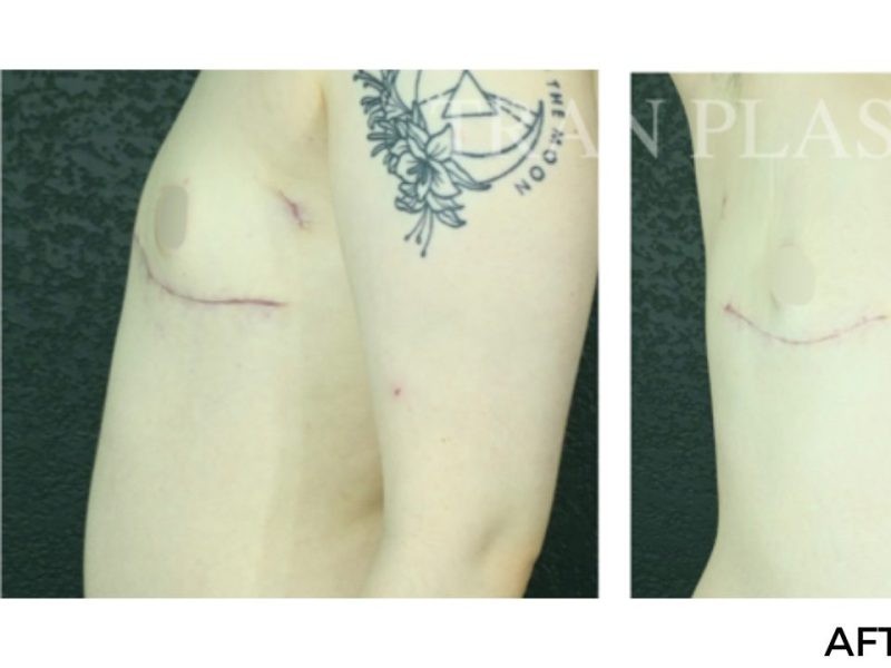Procedure before and after - before