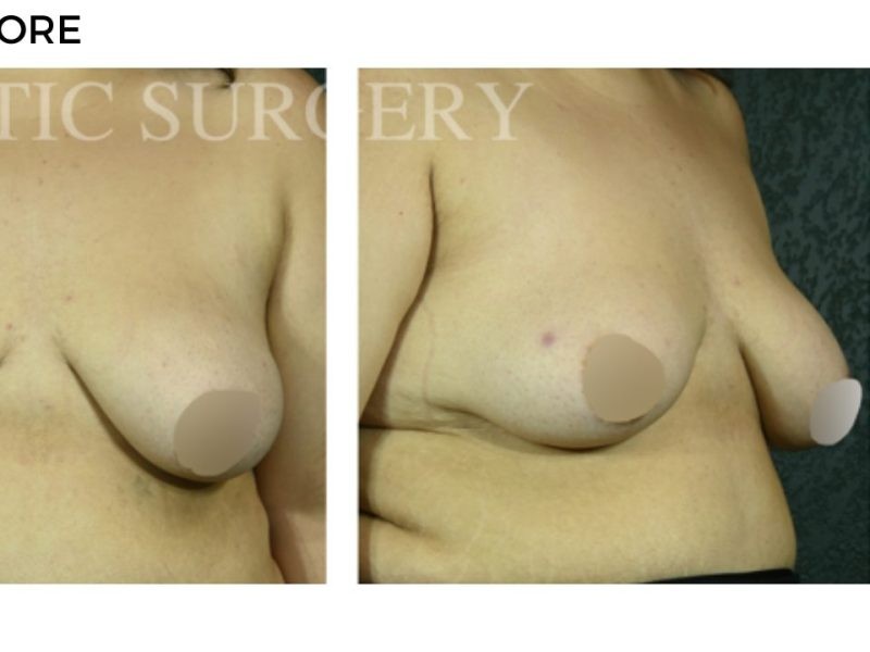 Procedure before and after - after