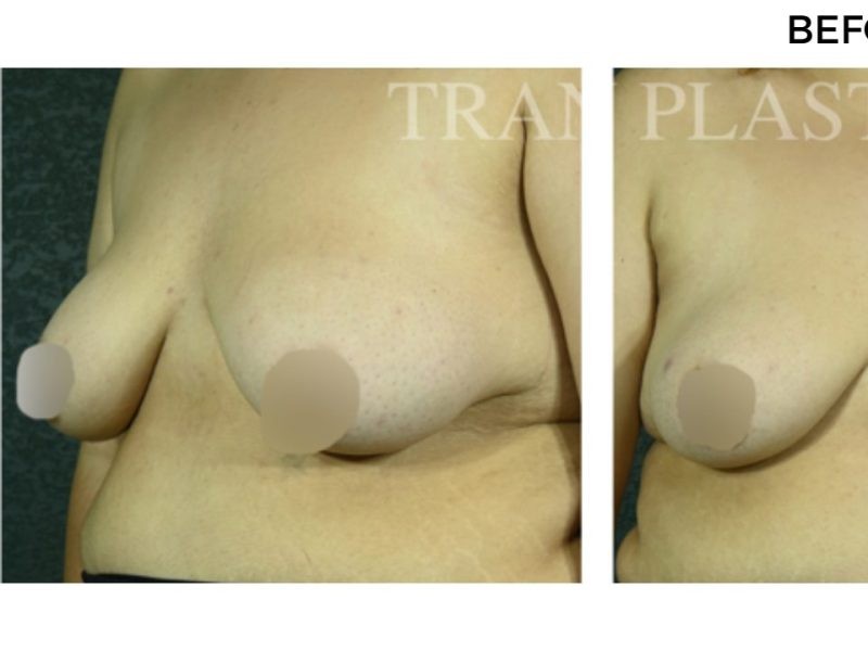 Procedure before and after - before