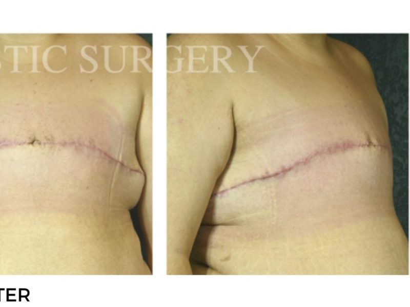 Procedure before and after - after