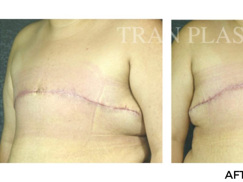 Procedure before and after - before