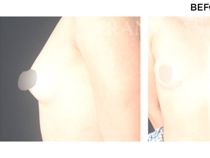 Procedure before and after - before