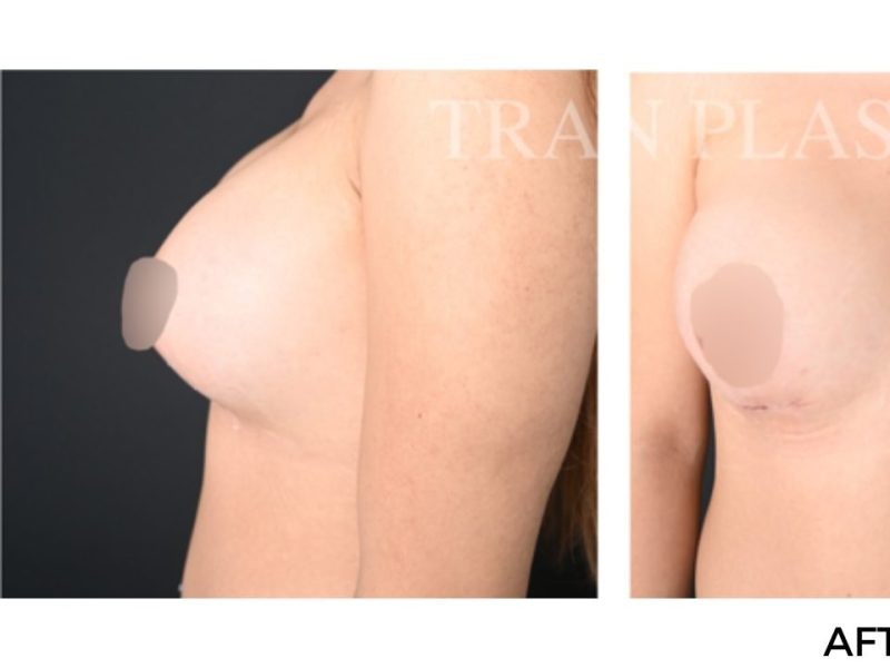 Procedure before and after - before