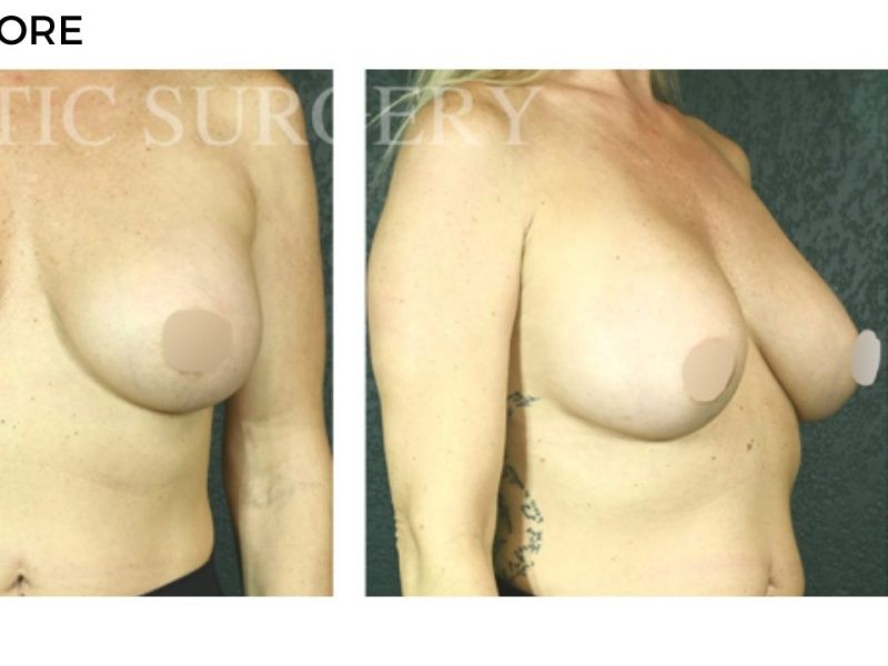 Procedure before and after - after