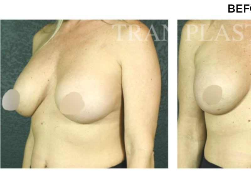 Procedure before and after - before