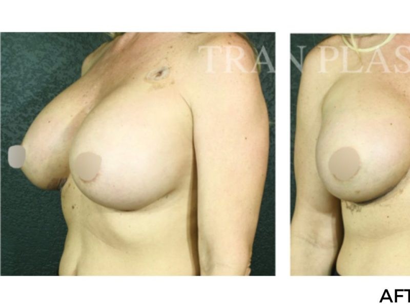 Procedure before and after - before