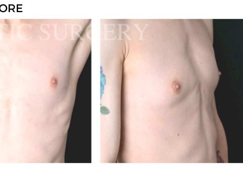 Procedure before and after - after