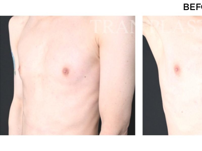 Procedure before and after - before