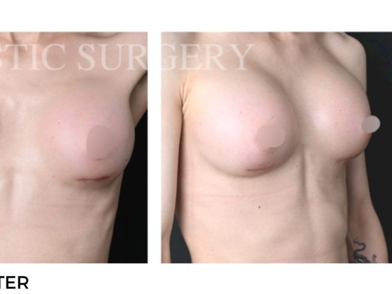 Procedure before and after - after