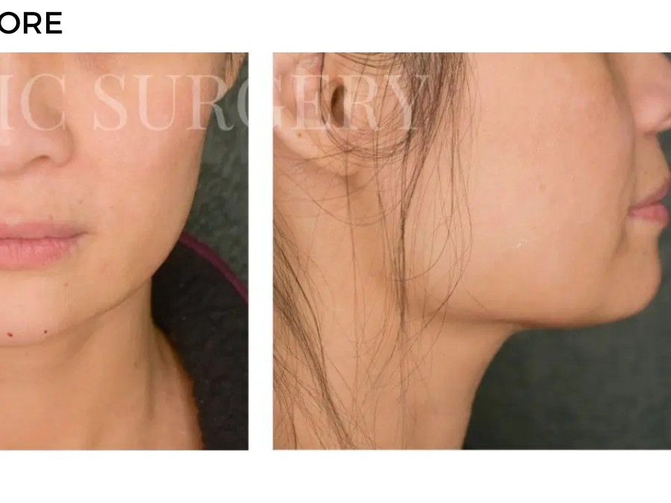 Procedure before and after - after