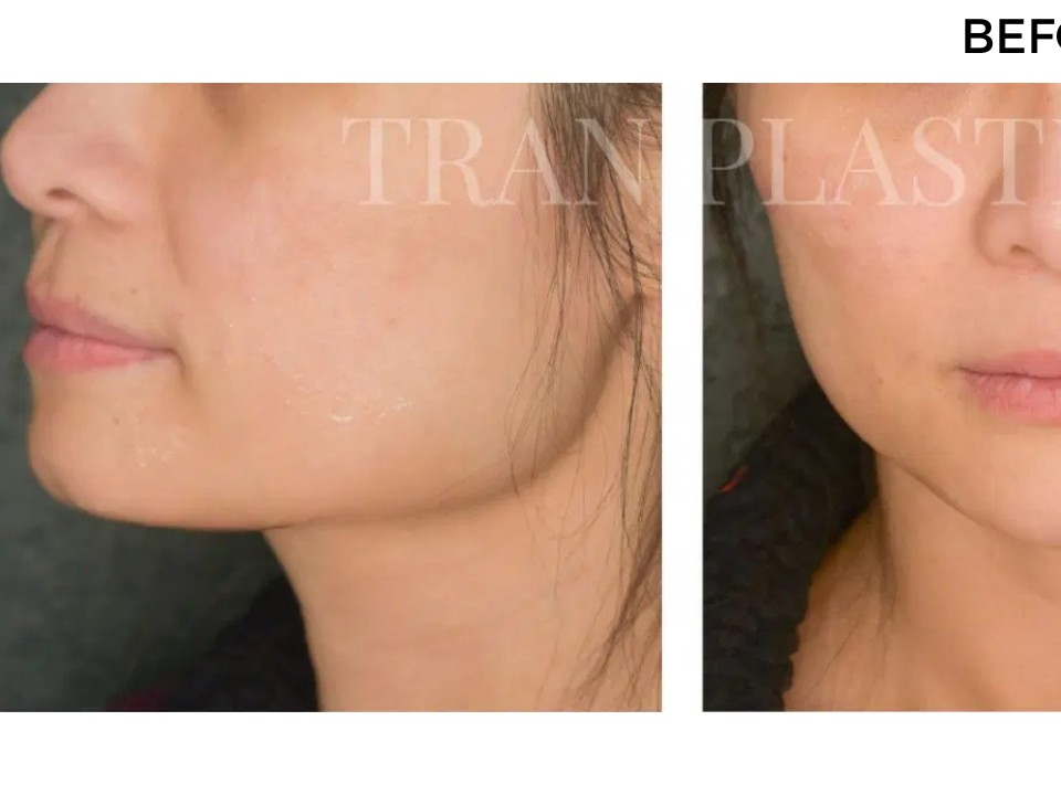 Procedure before and after - before