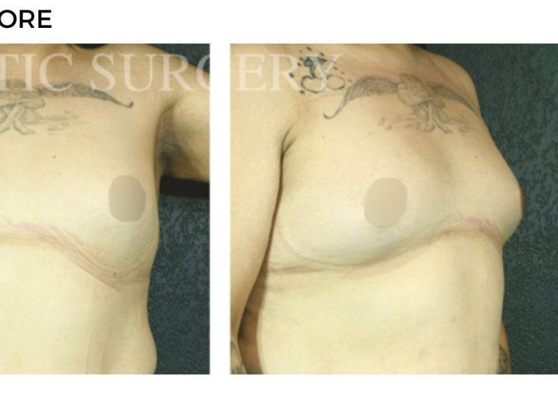 Procedure before and after - after