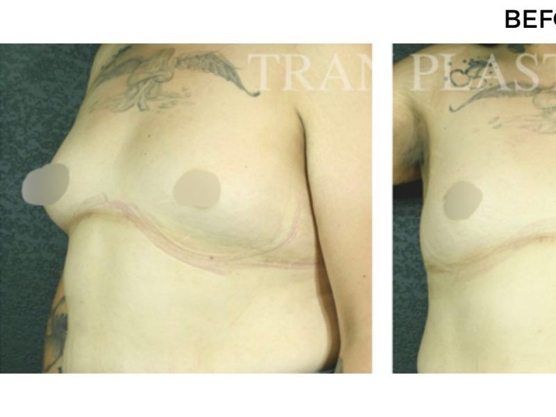 Procedure before and after - before