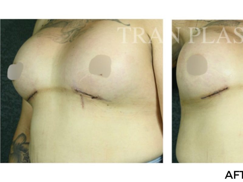 Procedure before and after - before