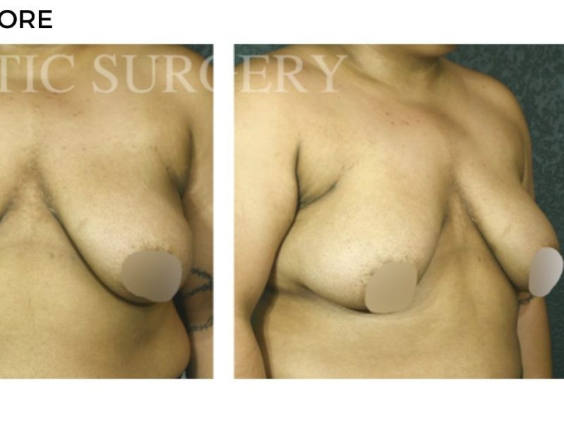 Procedure before and after - after