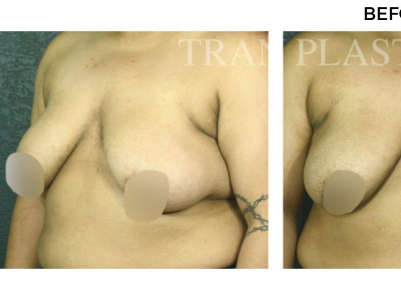 Procedure before and after - before