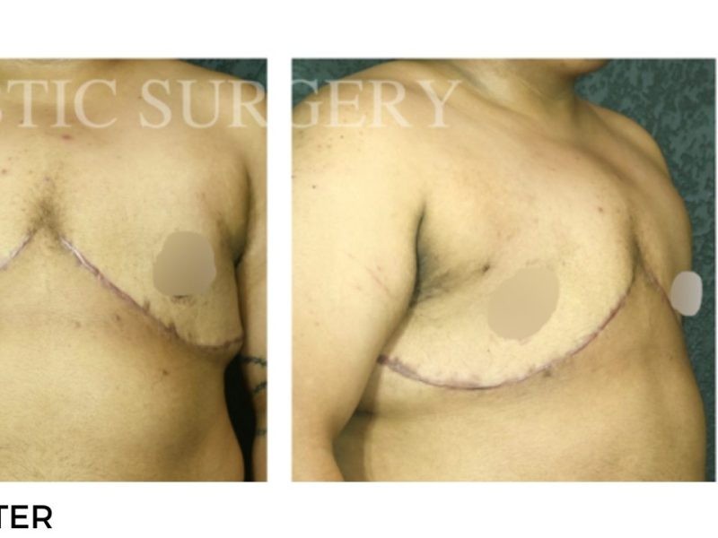 Procedure before and after - after
