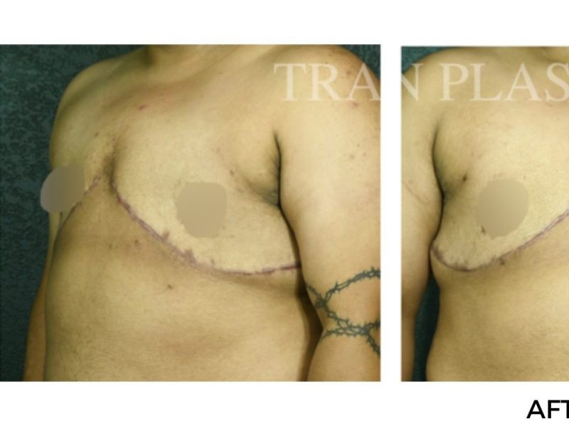 Procedure before and after - before