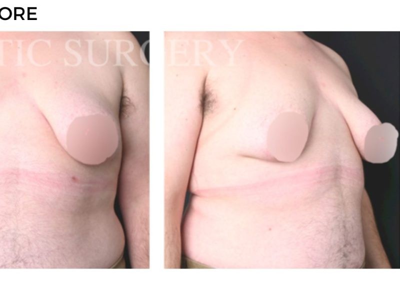Procedure before and after - after
